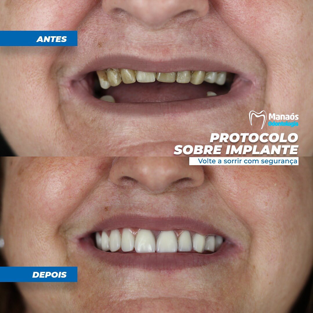 Recuperação do sorriso