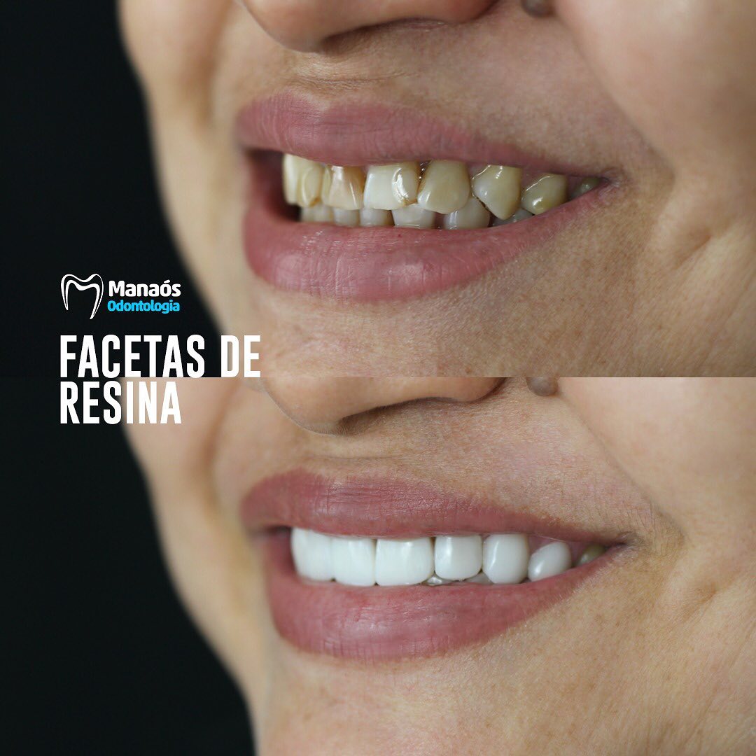 Resultado natural